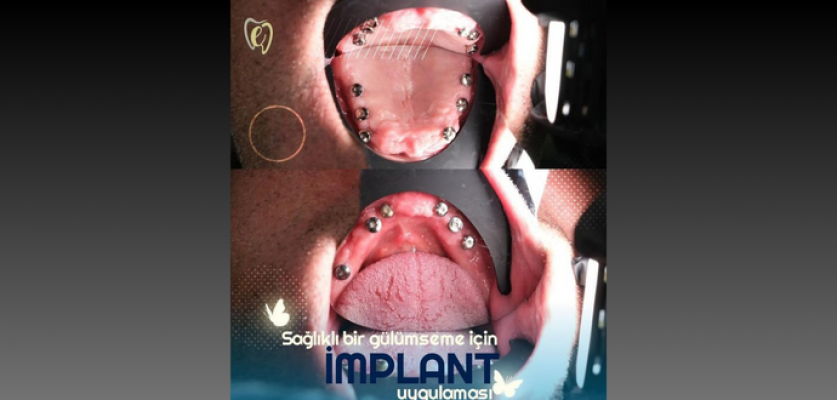 Implant Treatment