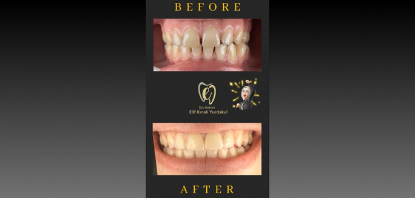 Laminate Veneers